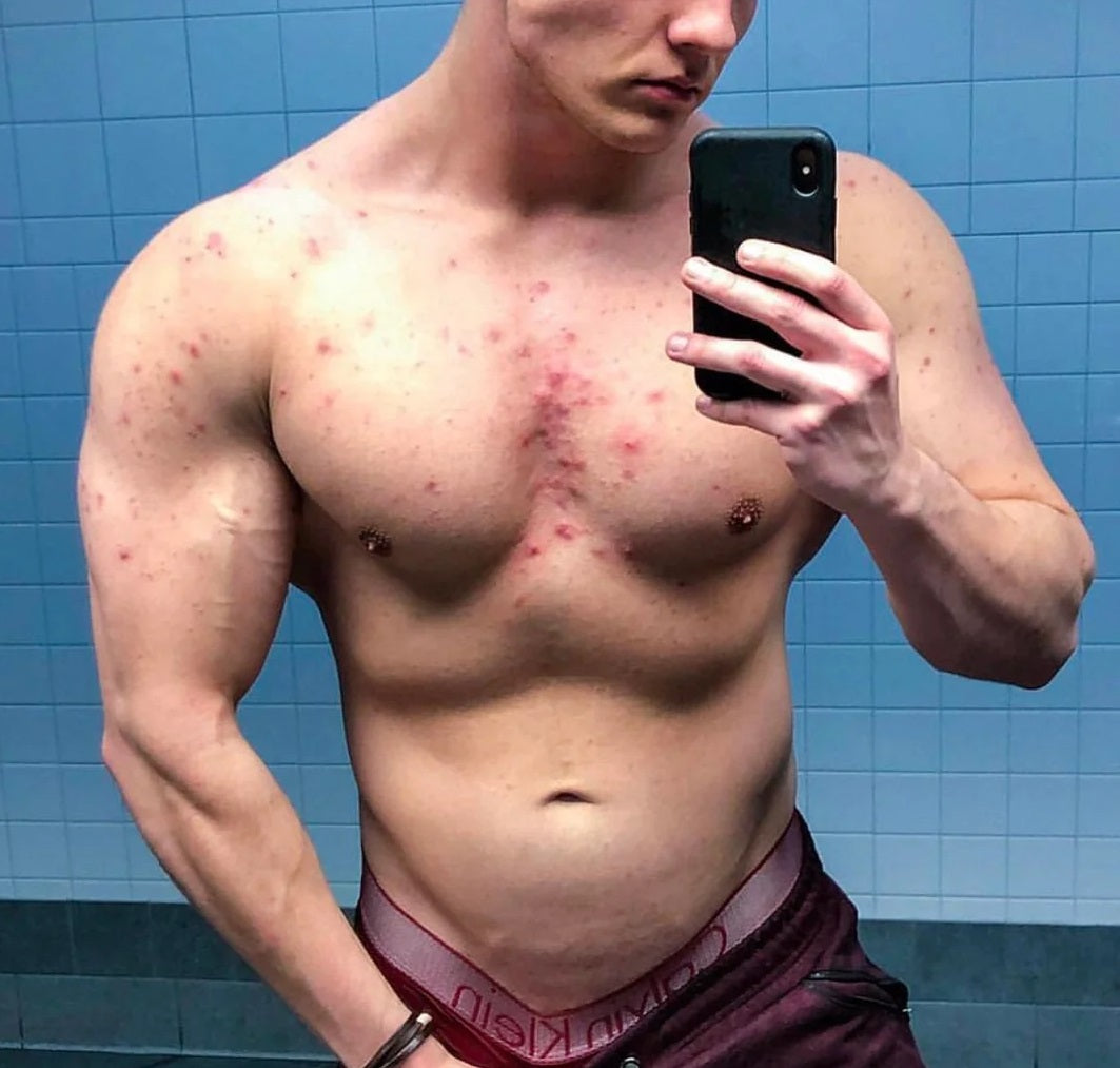 Bodybuilder Acne - How to Stop It